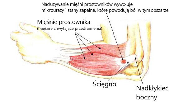 Struktura łokcia tenisisty i umiejscowienie anatomiczne bólu